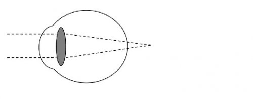 Hyperopia (long-sight or far-sightedness)