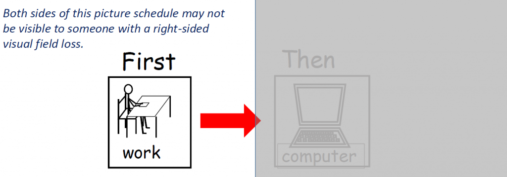 Right sided visual field loss